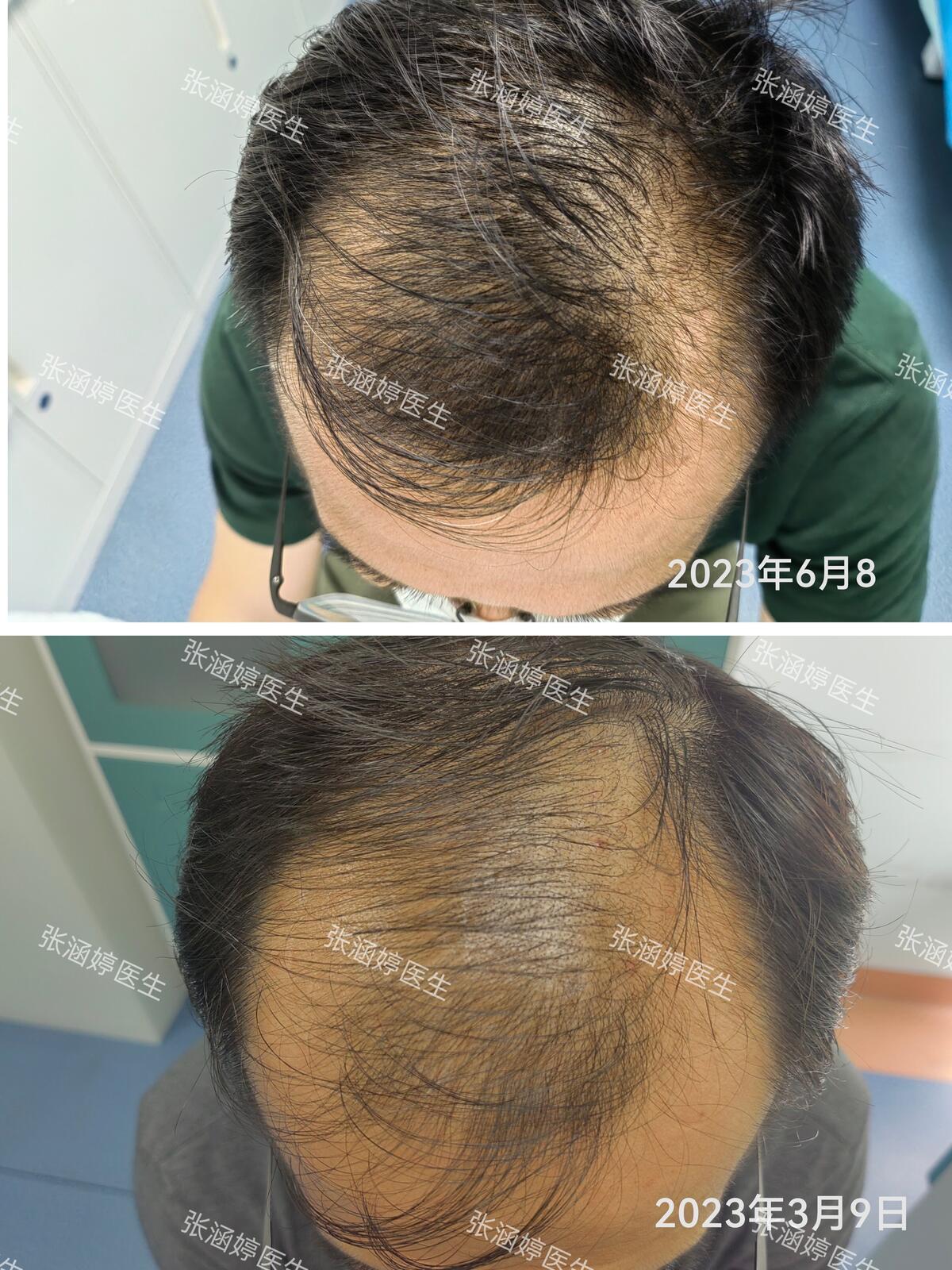 最新脫發(fā)技術(shù)，探索治療脫發(fā)的新途徑