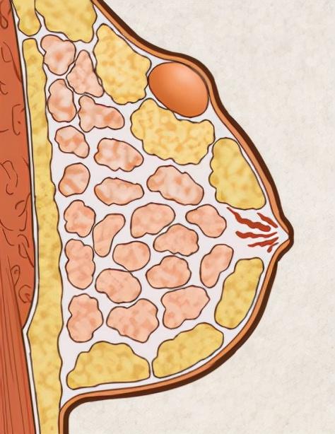 最新乳腺分型研究，探索乳腺癌診療的新領(lǐng)域